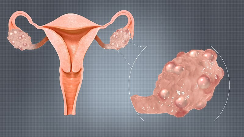 Syndróm polycystických vaječníkov. Polycystické vaječníky