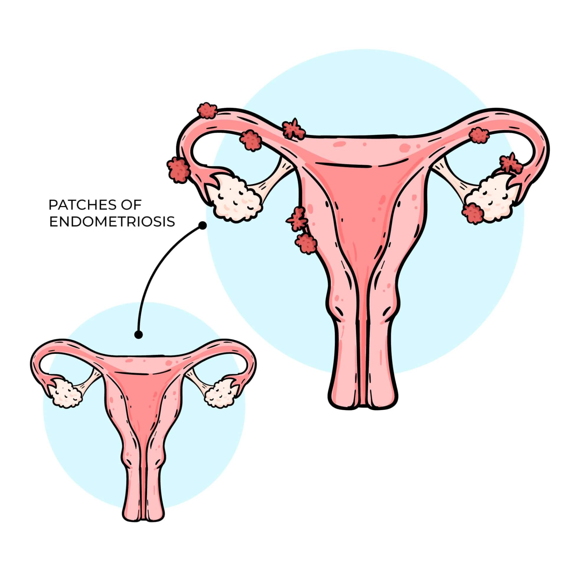 Endometrióza